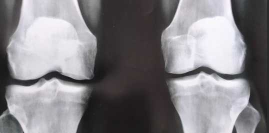 Рентген колена или МРТ что лучше