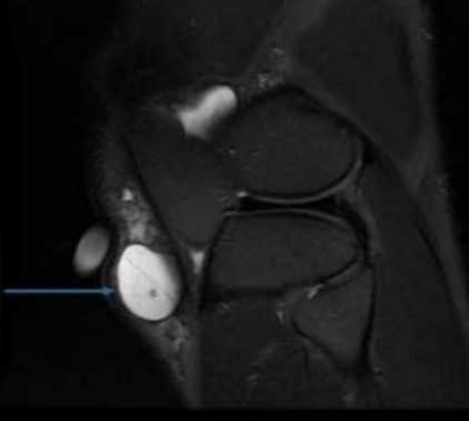 На МРТ патология выглядит как жидкостное образование