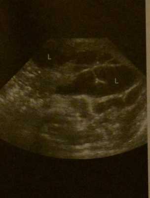 Снимки МРТ и КТ. Лимфангиома у детей