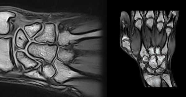 мрт кисти руки