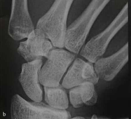 Снимки МРТ и КТ. Перелом ладьевидной кости