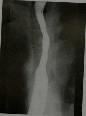 Снимки МРТ и КТ. Дивертикулы пищевода