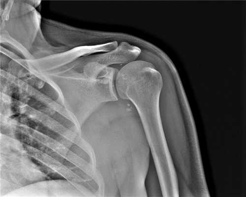 КТ плечевого сустава