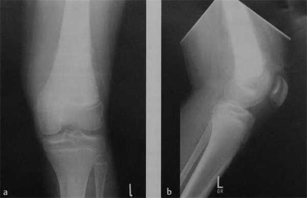 Снимки МРТ и КТ. Остеосаркома
