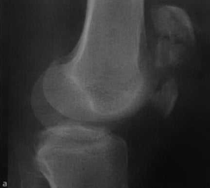 Снимки МРТ и КТ. Перелом надколенника