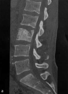 Снимки МРТ и КТ. Лимфома кости