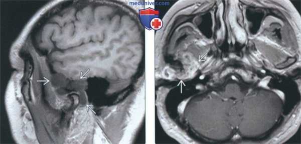 КТ, МРТ при хондросаркоме височно-нижнечелюстного сустава (ВНЧС)
