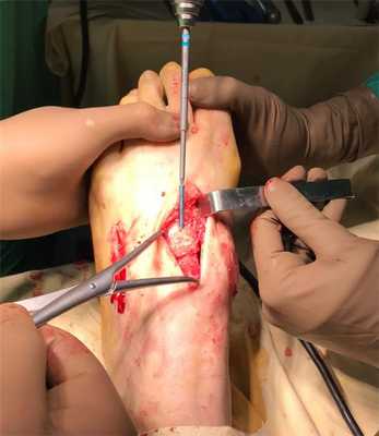 переломовывих в суставе Лисфранка операция