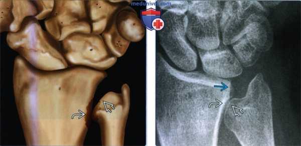 Признаки локтевого импиджмент-синдрома