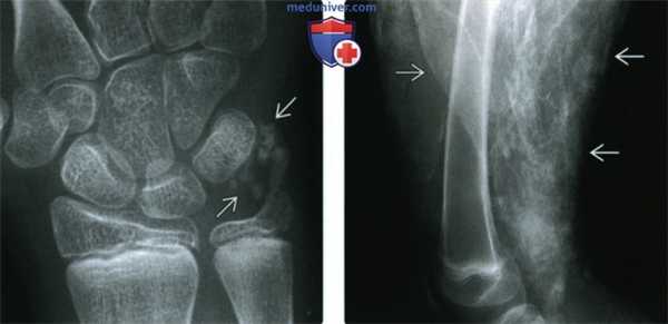 Рентгенограмма, КТ, МРТ при прогрессирующем системном склерозе