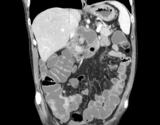 Как делают МРТ кишечника