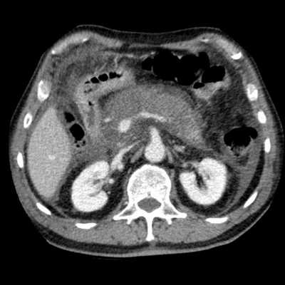 КТ-острый-панкреатит