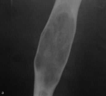 Снимки МРТ и КТ. Фиброзная дисплазия - болезнь Брайцева