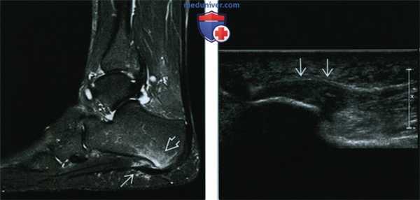 Признаки подошвенного фасциита