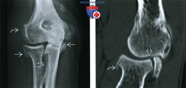 Рентгенограмма, КТ, МРТ при остеоартрозе плечевого и локтевого суставов