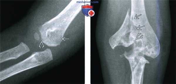 Рентгенограмма, КТ, МРТ, УЗИ при переломе медиального мыщелка локтевого сустава