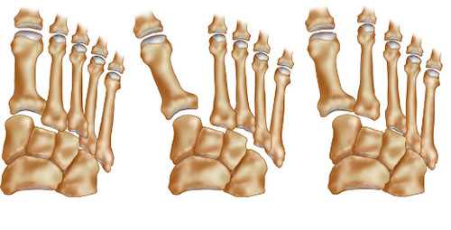 схема повреждений Лисфранка