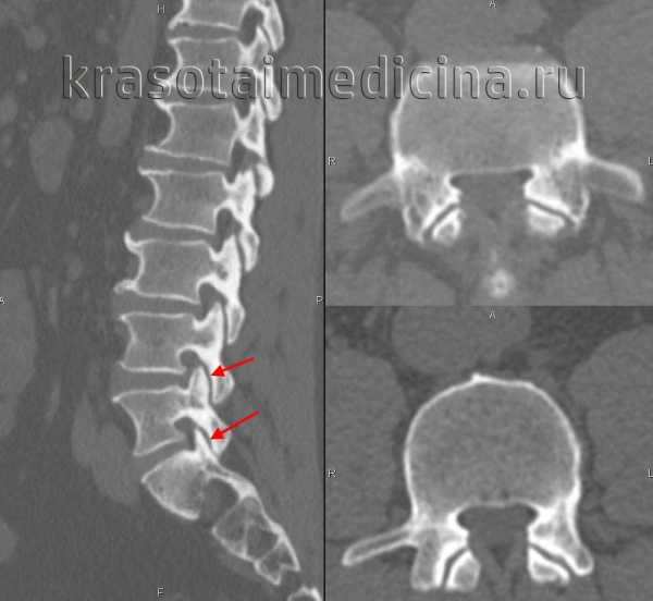 Шейный спондилоартроз