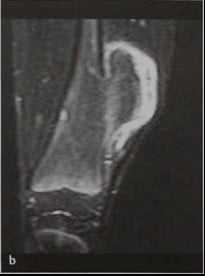 Снимки МРТ и КТ. Остеохондрома