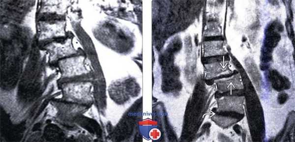 МРТ при дегенеративном сколиозе позвоночника