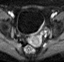 МРТ малого таза в диагностике заболеваний мочевого пузыря