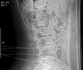 10 11 5 Вертеброгенная люмбалгия пациент