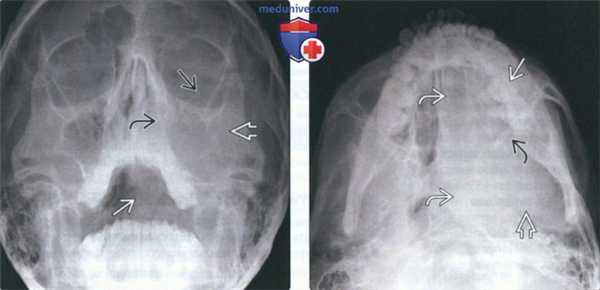Рентгенограмма, КТ, сцинтиграфия при саркоме Юинга челюсти
