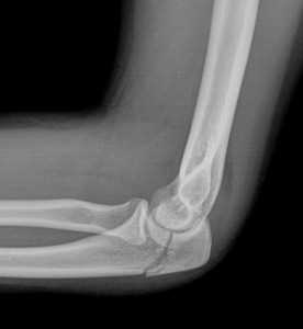 перелом локтевого отростка-обр.