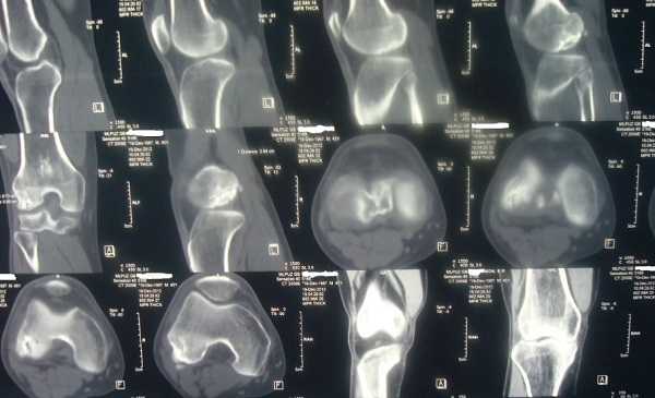 Рентген колена или МРТ что лучше