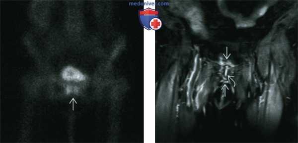 Нетравматический остеит лобковой кости - лучевая диагностика