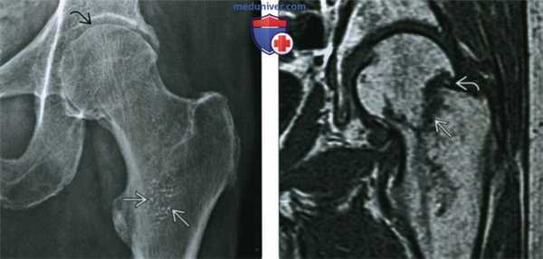 Рентгенограмма, КТ, МРТ, УЗИ при первичном остеопорозе