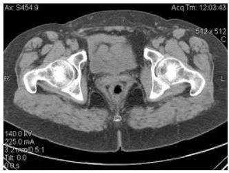 КТ тазобедренного сустава фото