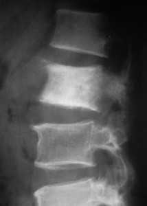 метастаз рака предст-обр