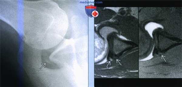 Признаки повреждения Беннетта