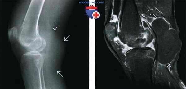 Рентгенограмма, МРТ при ревматоидном артрите коленного сустава