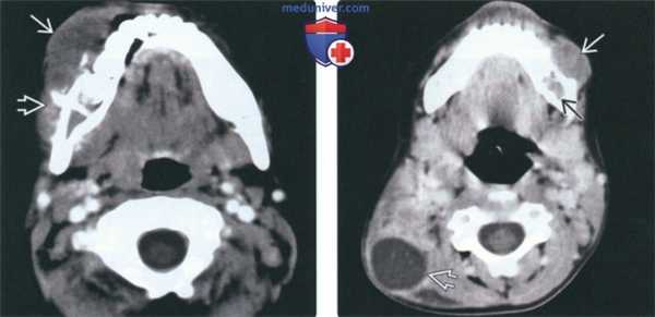 Рентгенограмма, КТ, МРТ при лимфоме Беркитта челюсти