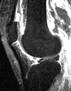 септический артрит коленного сустава