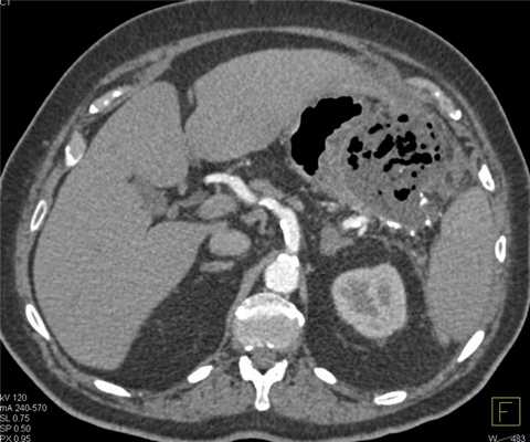 панкреонекроз-абсцесс