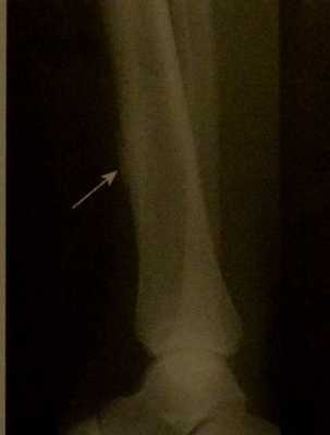 Снимки МРТ и КТ. Остеосаркома у детей