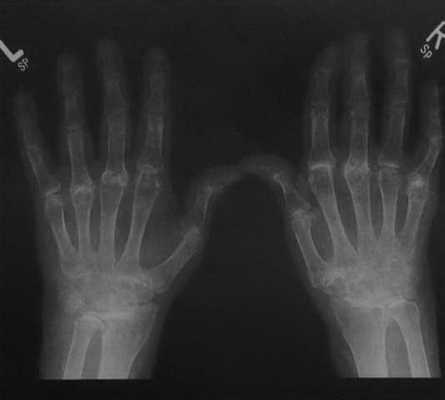 Снимки МРТ и КТ. Ревматоидный артрит - болезнь Стила