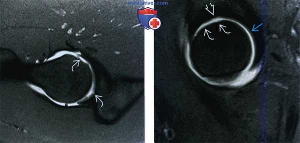 Рентгенограмма, КТ, МРТ при хрящевой и костно-хрящевой патологии тазобедренного сустава