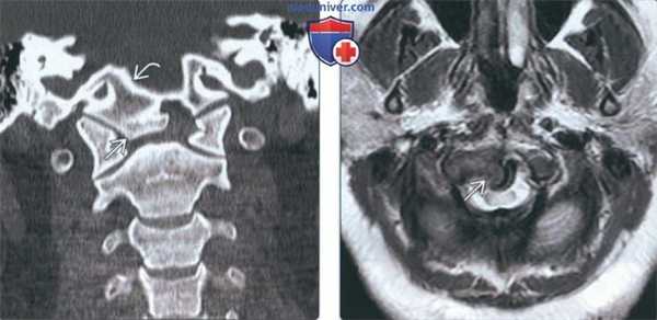 Лучевая диагностика птичьей кости