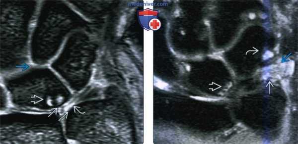 Рентгенограмма, КТ, МРТ при синдроме сдавливания запястья