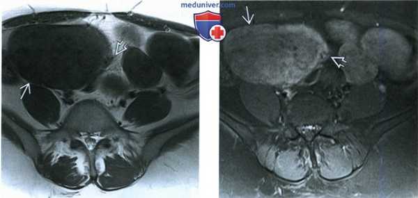 КТ, МРТ, УЗИ при паразитирующей миоме