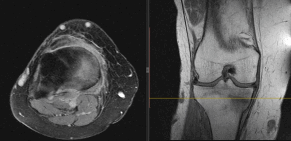 Расшифровка и как выглядят переломы на снимке МРТ