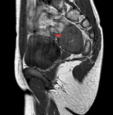Тератома яичника (МРТ)