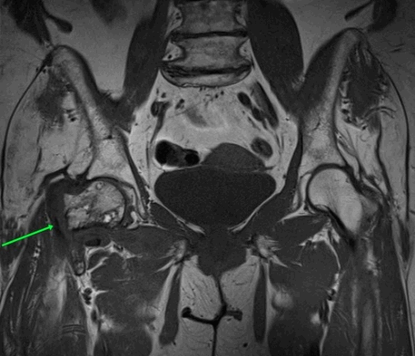 При повреждении каких костей можно делать МРТ