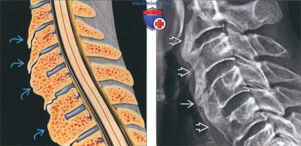 Лучевая диагностика диффузного идиопатического скелетного гиперостоза