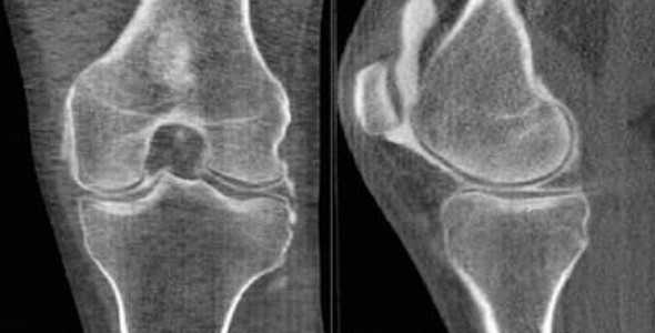 Компьютерная томография колена