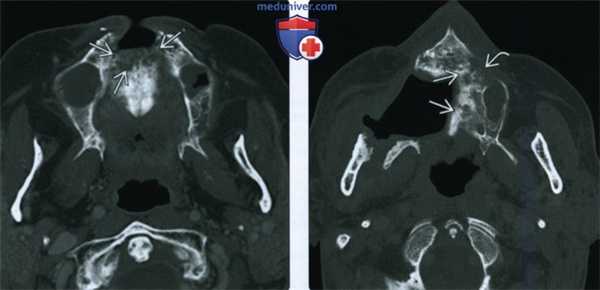 КТ, МРТ при остеорадионекрозе нижней и верхней челюсти